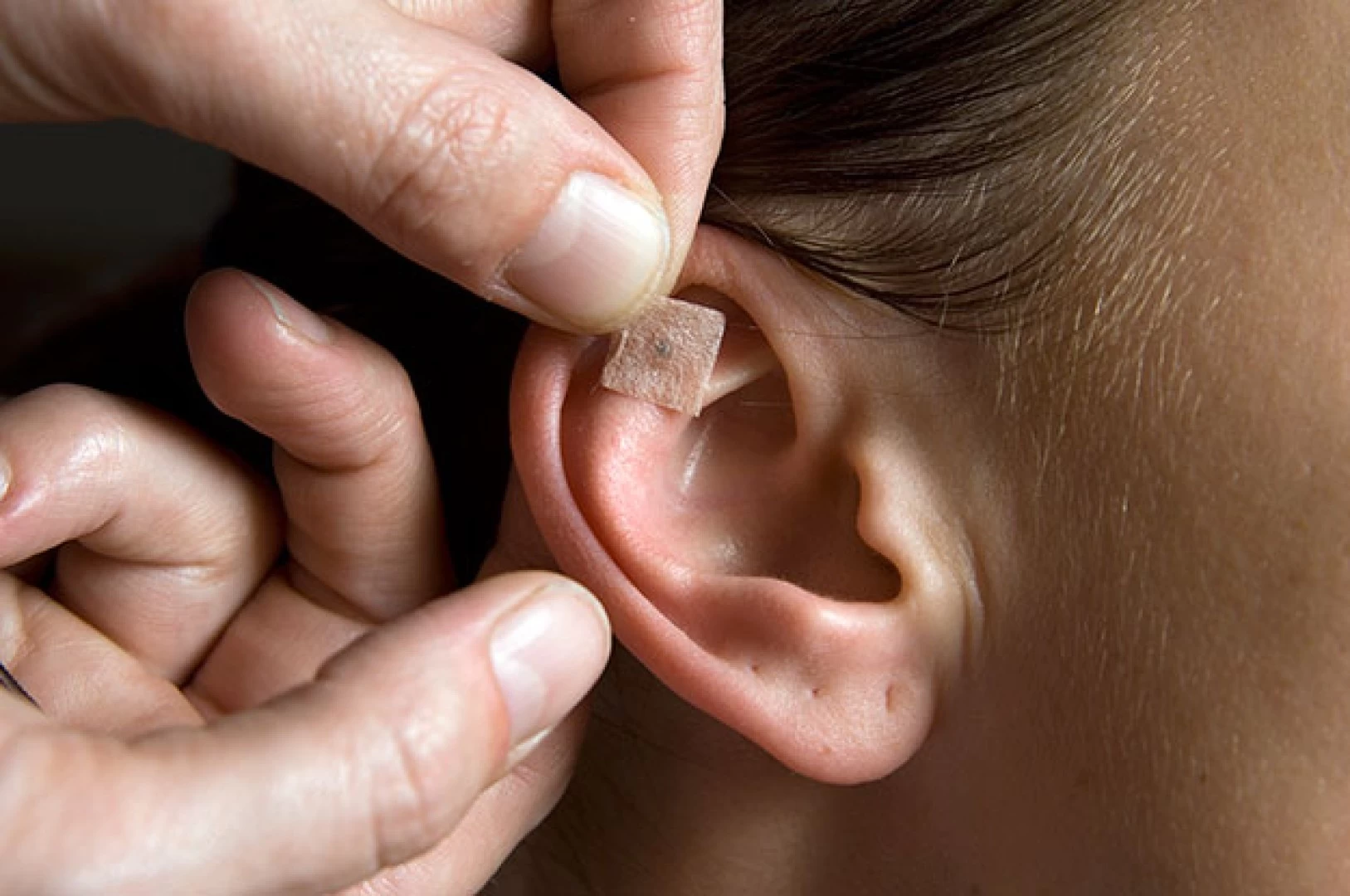 Auriculoterapia